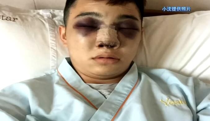 小伙隆鼻失败鼻头肿成馒头 术后一度变成熊猫眼